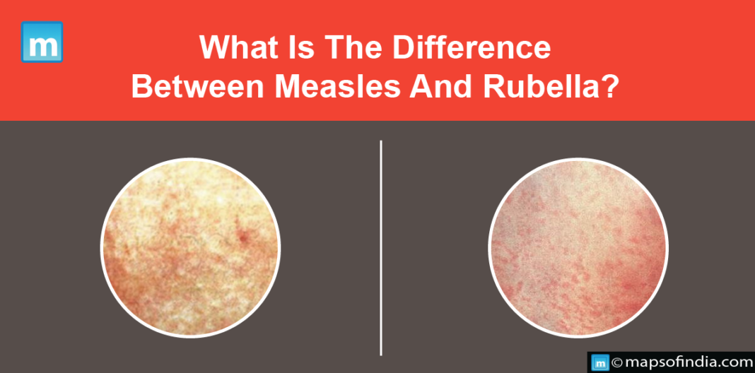 What Is The Difference Between Measles And Rubella Government