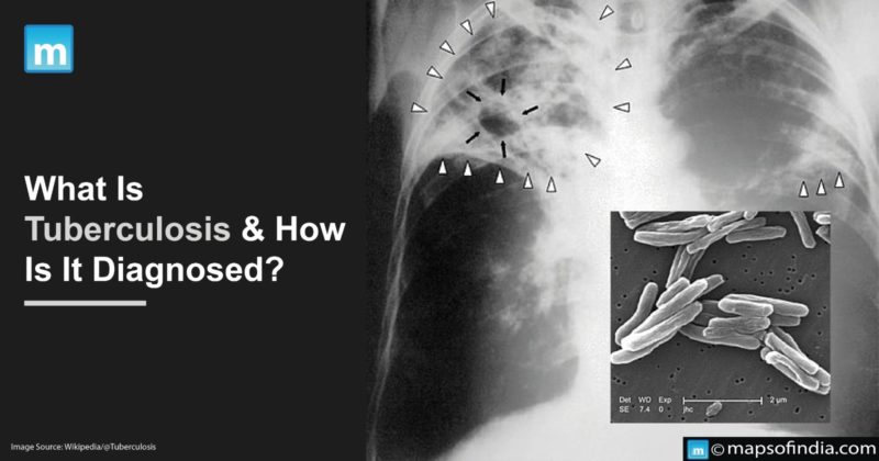 What Is Tuberculosis And How Is It Diagnosed? - Care