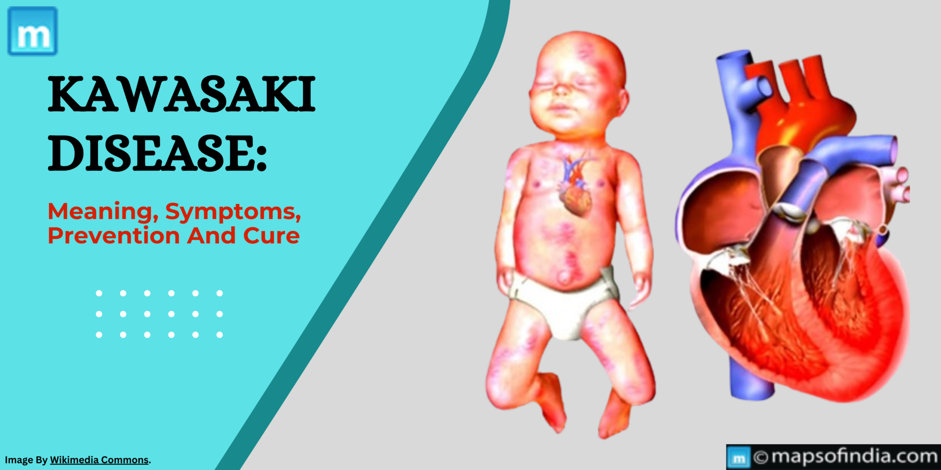 Kawasaki Disease: Meaning, Symptoms, Prevention And Cure - Health