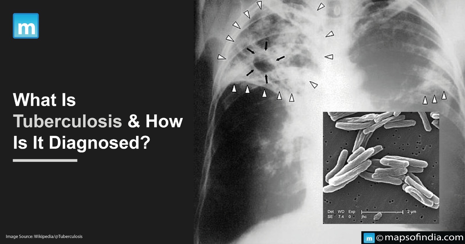 What Is Tuberculosis And How Is It Diagnosed?