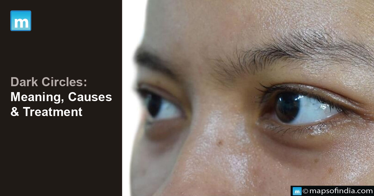 Dark Circles: Meaning, Causes And Treatment