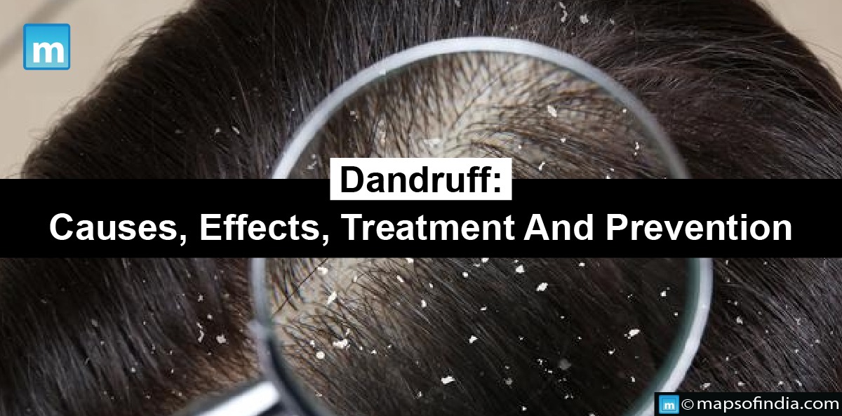 Dandruff: Causes, Effects, Treatments And Preventions