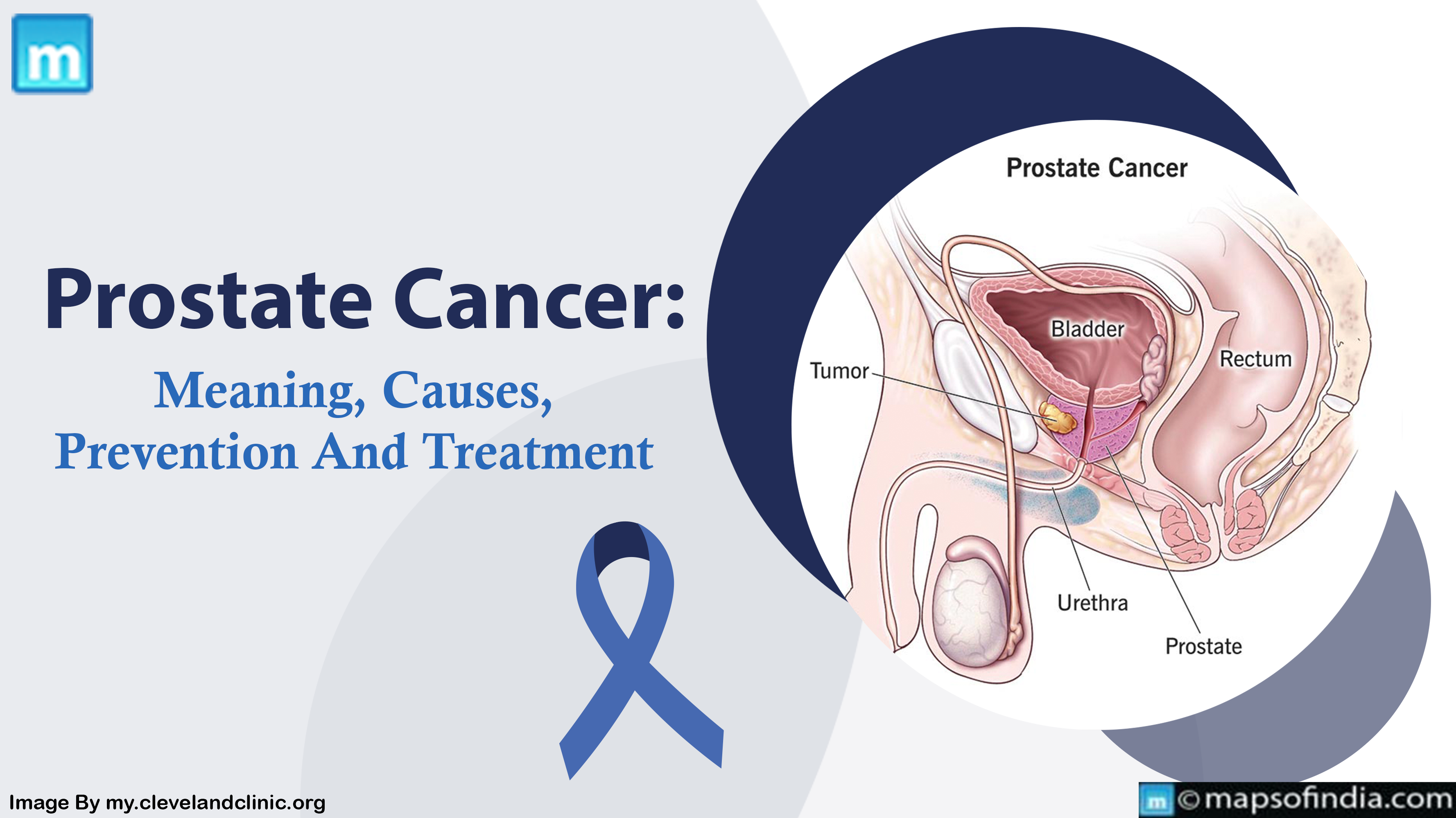 Prostate Cancer: Meaning, Causes, Prevention And Treatment