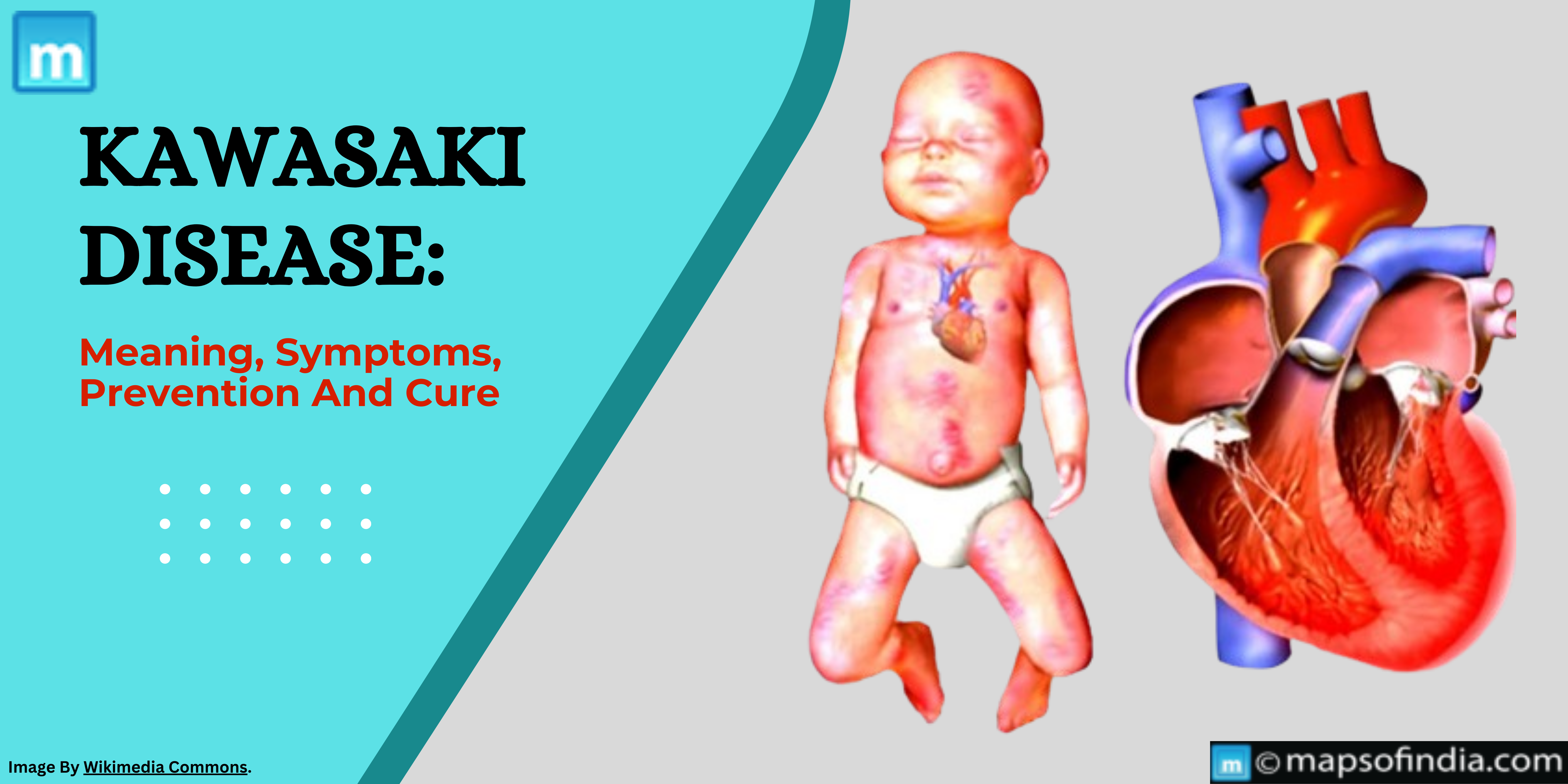 Kawasaki Disease: Meaning, Symptoms, Prevention And Cure